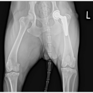 X-ray of a "cementless" hip replacement